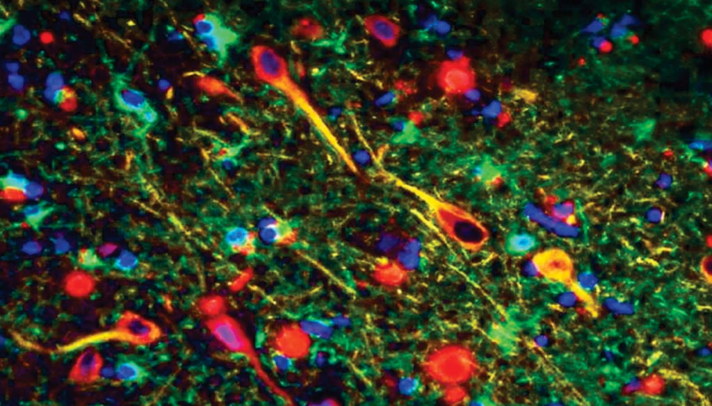 Image: Porphyromonas gingivalis gingipains in the neurons of Alzheimer\'s brain. P. gingivalis gingipains = red, neurons = yellow, astrocytes = green (Photo courtesy of Cortexyme).