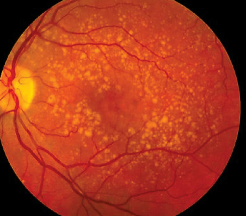 Image: A fundus photo showing intermediate age-related macular degeneration (Photo courtesy of National Eye Institute).