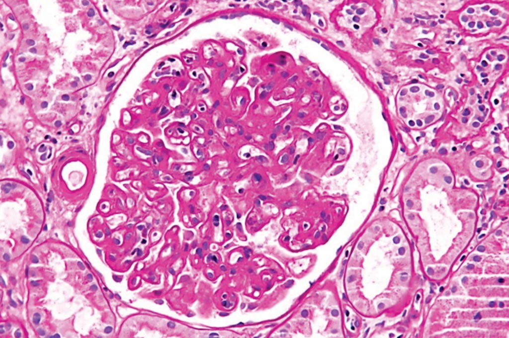 Image: A photomicrograph of a glomerulus with changes characteristic of a transplant glomerulopathy. Transplant glomerulopathy is considered a form of chronic antibody-mediated rejection (Photo courtesy of Nephron).