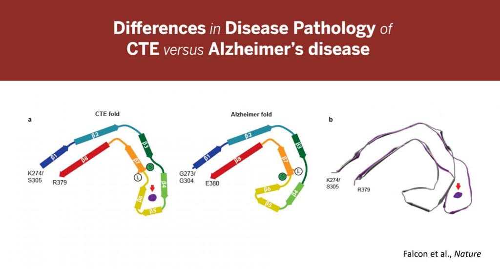 Image: These images highlight the differences found in the tau folds associated with Alzheimer\'s disease and Chronic Traumatic Encephalopathy (CTE). They also show an unidentified element found in CTE that does not exist in Alzheimer\'s disease (Photo courtesy of Indiana University School of Medicine).
