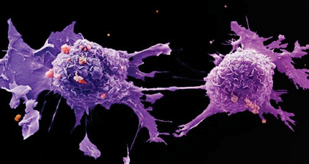 Image: A scanning electron micrograph (SEM) of lung cancer cells (Photo courtesy of Cancer Research UK).