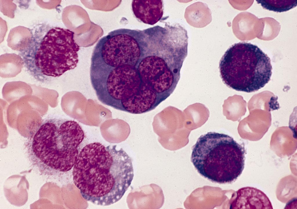 Image: A bone marrow smear from a case of acute erythroid leukemia showing a multinucleated erythroblast with megaloblastoid nuclear chromatin (Photo courtesy of Wikimedia Commons).
