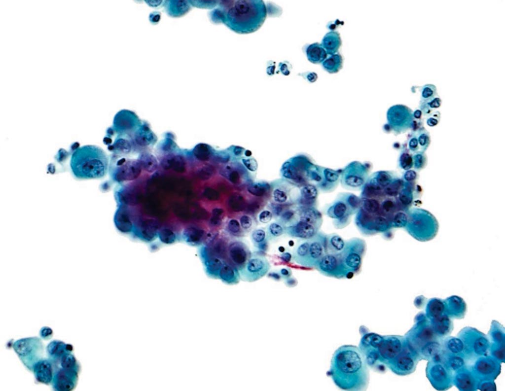 Image: A photomicrograph of a pleural fluid cytopathology specimen showing mesothelioma (Photo courtesy of Nephron).