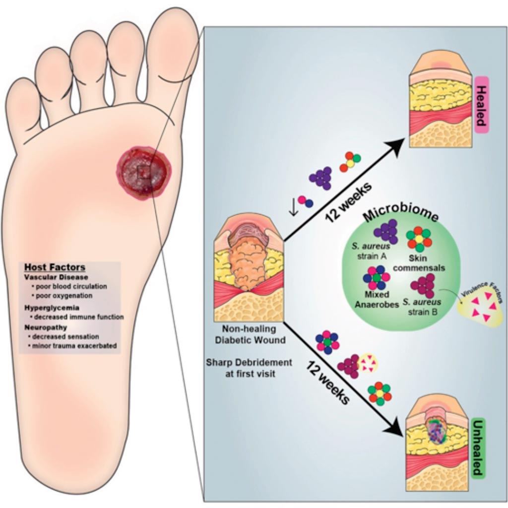 Image: A graphic representation of Strain- and Species-Level Variation in the Microbiome of Diabetic Wounds Is Associated with Clinical Outcomes and Therapeutic Efficacy (Photo courtesy of the University of Pennsylvania).