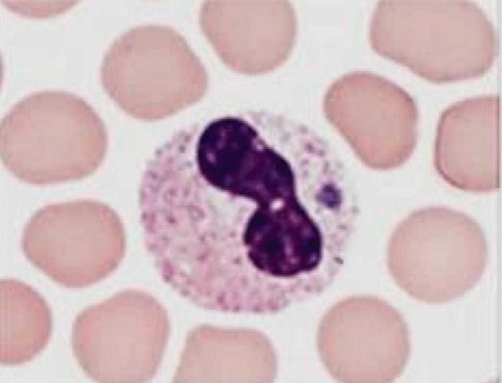Image: A visualization of morulae in the cytoplasm of a granulocyte during examination of blood smears is highly suggestive of a diagnosis of Human Granulocytic Anaplasmosis (Photo courtesy of the US Centers for Disease Control and Prevention).