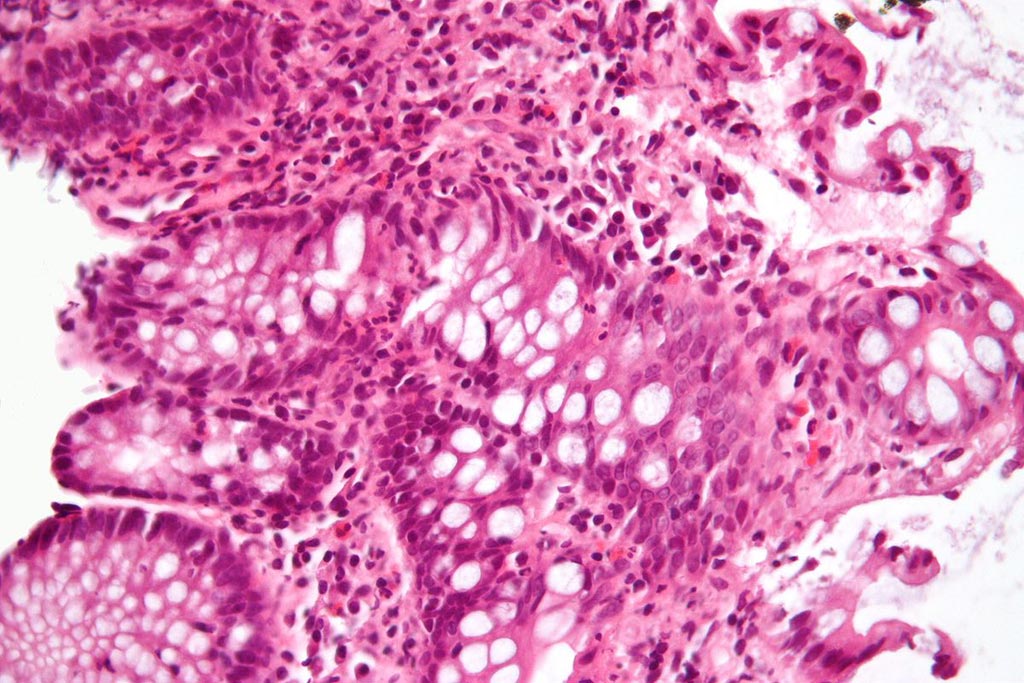 Image: A micrograph of a colonic biopsy showing inflammation of the large bowel in a case of inflammatory bowel disease (Photo courtesy of Wikimedia Commons).
