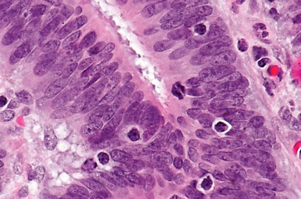 Image: A photomicrograph showing tumor-infiltrating lymphocytes in a case of colorectal cancer with evidence of high microsatellite instability (MSI-H) on immunostaining (Photo courtesy of Nephron).