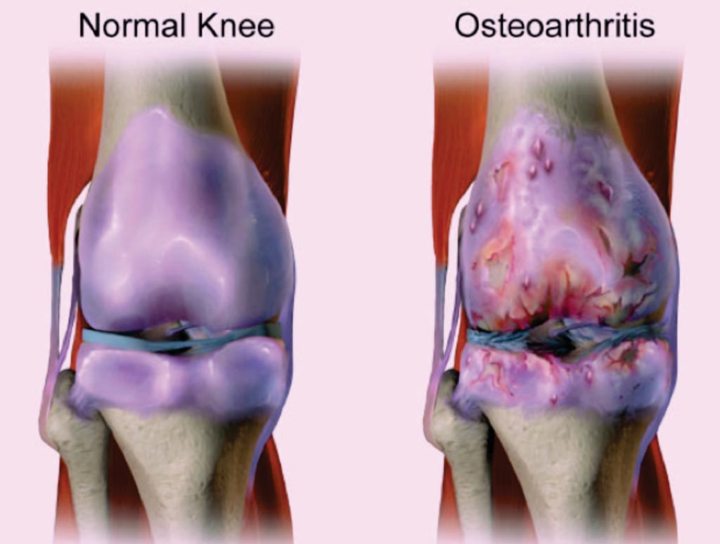 Image: Knee osteoarthritis, also known as degenerative joint disease, is typically the result of wear and tear and progressive loss of articular cartilage (Photo courtesy of Bruce Blaus).