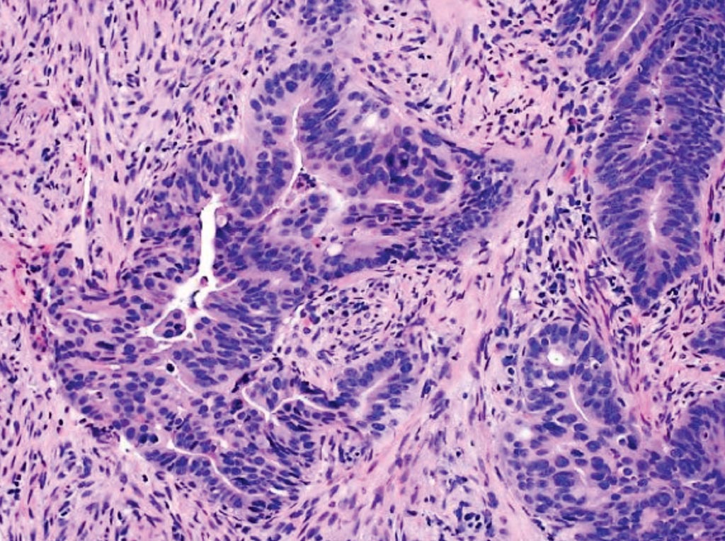 Image: A histopathology of colorectal carcinoma: an example of moderately differentiated adenocarcinoma showing complicated glandular structures in a desmoplastic stroma (Photo courtesy of the David Geffen School of Medicine at the University of California).