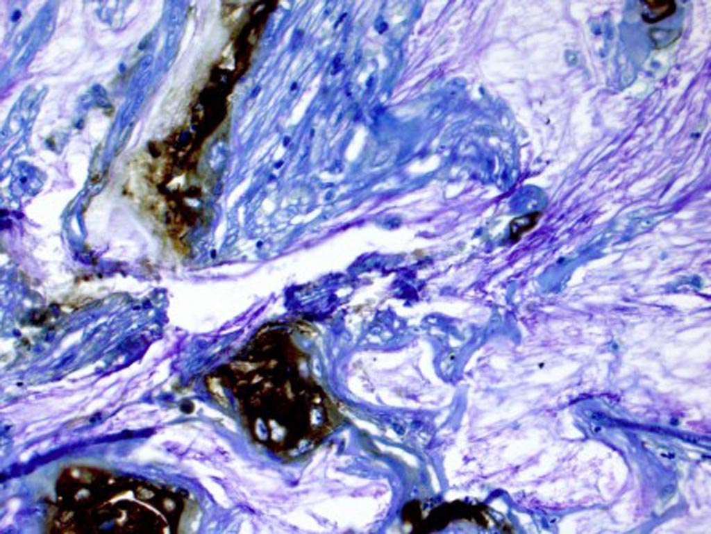 In this photomicrograph, the brown areas were stained for a biomarker in tissue from a patient who developed pancreatic cancer from a cyst (Photo courtesy of Dr. Koushik Das, Washington University).