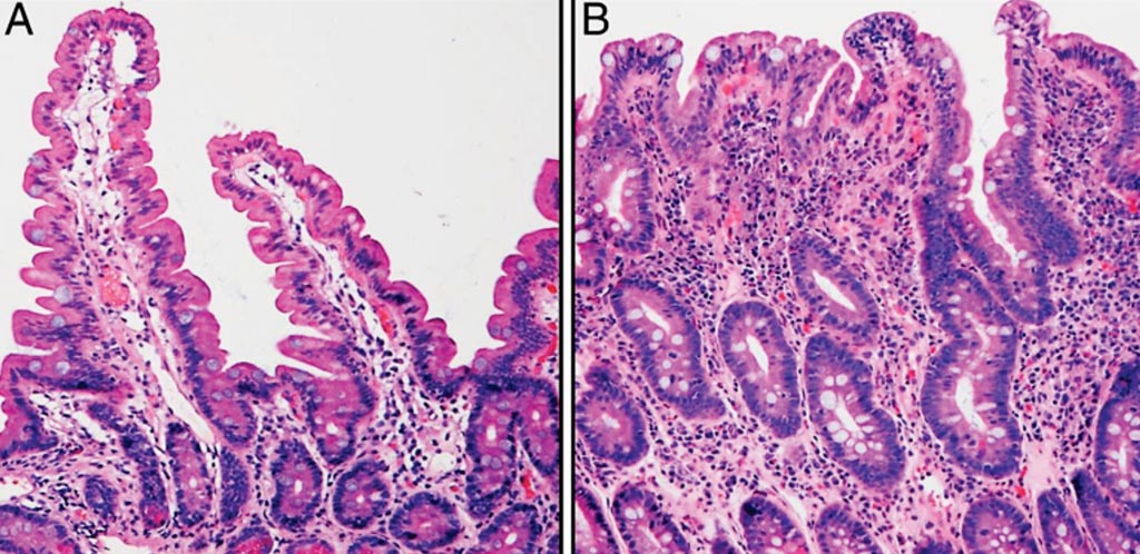 Representative histologic features of the small intestine. In the normal duodenal biopsy (A), the villi are elongated and the crypts relatively short. This is in contrast to the small intestinal tissue affected by celiac disease (B), which demonstrates marked villus blunting and crypt hyperplasia. (Photo courtesy of Tracy R. Ediger MD, and Ivor D. Hill, MD ChB).