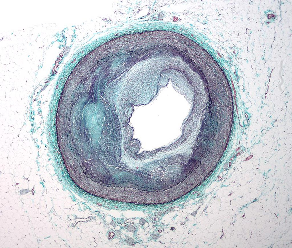 Image: A micrograph of a coronary artery with the most common form of coronary artery disease (atherosclerosis) and marked luminal narrowing (Photo courtesy of Wikimedia Commons).