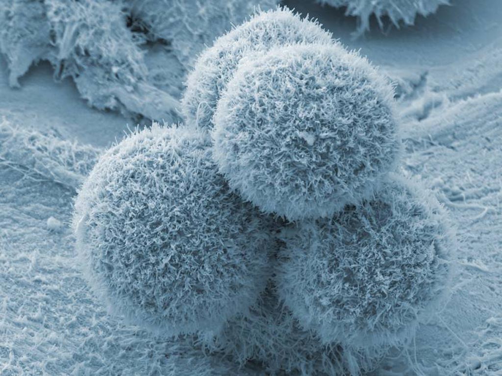Новое исследование подтвердило возможность использования опухолевых маркеров для выбора препаратов для химиотерапии у пациентов с метастатическим раком поджелудочной железы (фото любезно предоставлено SPL).