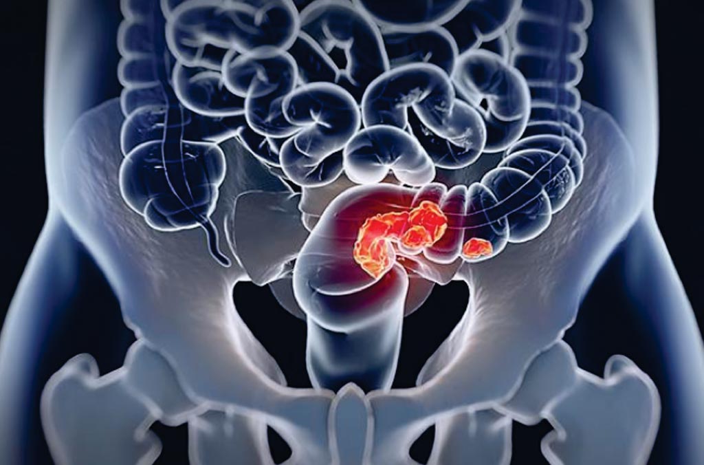 Image: Identifying a metastatic colorectal cancer patient’s Consensus Molecular Subtype (CMS) could help oncologists determine the most effective course of treatment (Photo courtesy of University of Southern California).