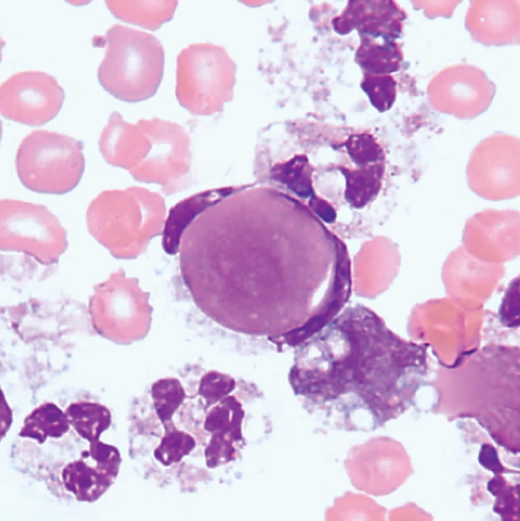 Image: Lupus Erythematosus (LE) Cells are neutrophils that have engulfed lymphocyte nuclei coated with and denatured by antibody to nucleoprotein (Photo courtesy of Dr. Moustafa Abdou).