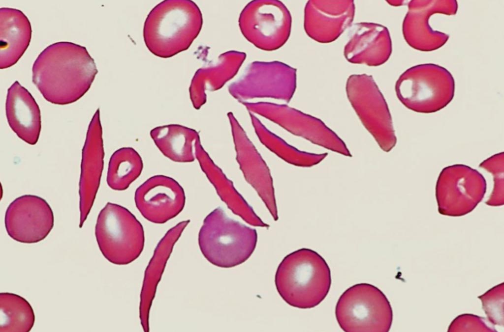 Image: A peripheral blood film from a patient with sickle cell disease (Photo courtesy of Venngage).