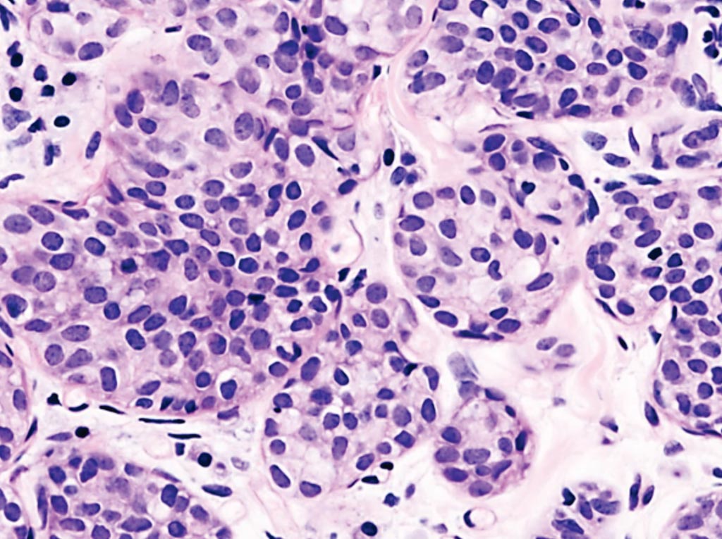 Image: A histological preparation from a patient with invasive lobular carcinoma, demonstrating a predominantly lobular growth pattern (Photo courtesy of KGH).