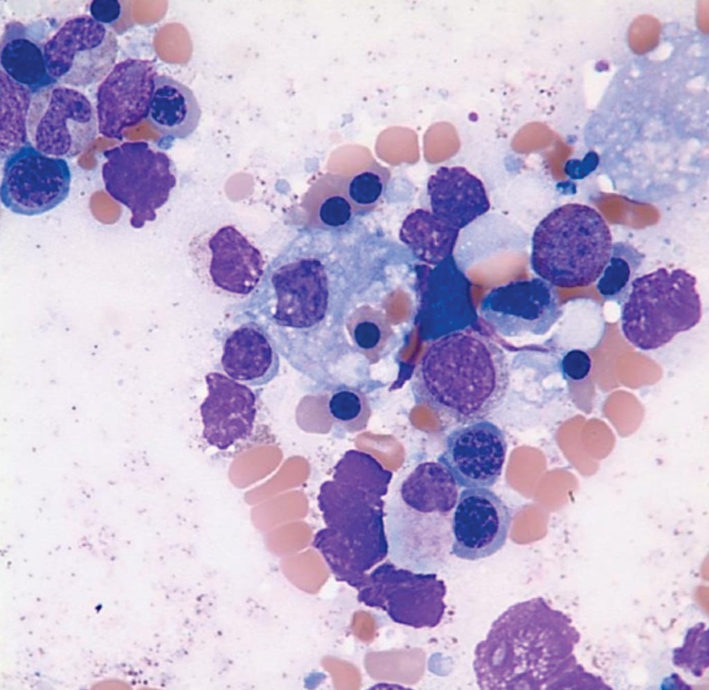 Image: A bone marrow aspirate from a patient suffering from Hemophagocytic Lymphohistiocytosis showing a macrophage that has ingested a nucleated red cell (Photo courtesy of UF).