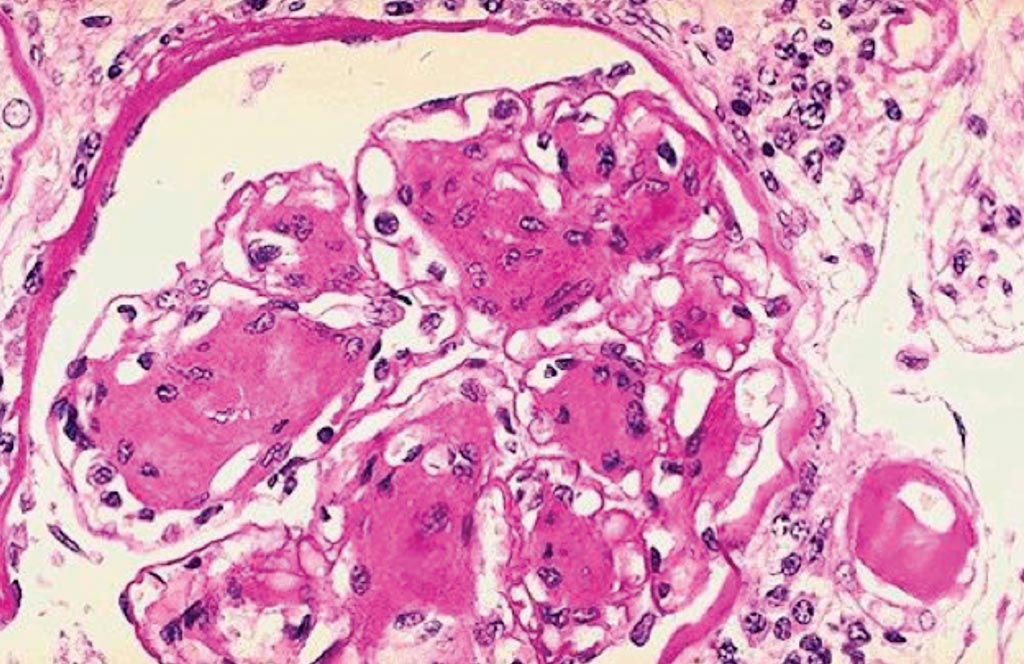 Image: A histopathology of nodular glomerulosclerosis in a patient with long-standing diabetes mellitus. Note the markedly thickened arteriole at the lower right, which is typical for the hyaline arteriolosclerosis that is seen in diabetic kidneys as well (Photo courtesy of University of Utah).
