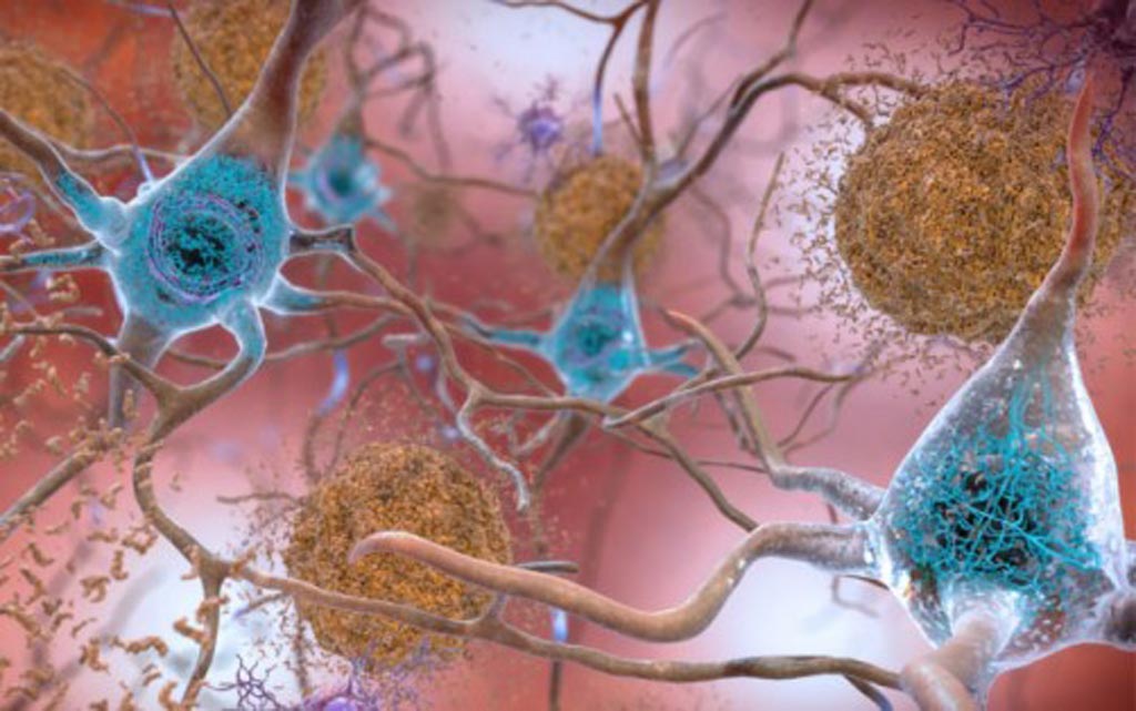 Image: In brains affected by Alzheimer’s disease, abnormal levels of the beta-amyloid protein clump together to form plaques (seen in brown) that collect between neurons and disrupt cell function. Abnormal collections of the tau protein accumulate and form tangles (seen in blue) within neurons, harming synaptic communication between nerve cells (Photo courtesy of the [U.S.] National Institute on Aging).