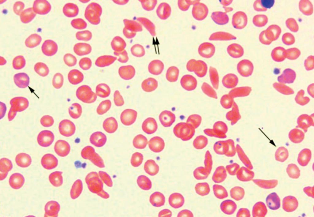 Image: A blood smear of a patient with Sickle Cell Disease. Polychromatophilic reticulocytes are present (small single arrow). Target cell (large single arrow) and sickle cell (double arrow) can be seen in this view (Photo courtesy of John Lazarchick).