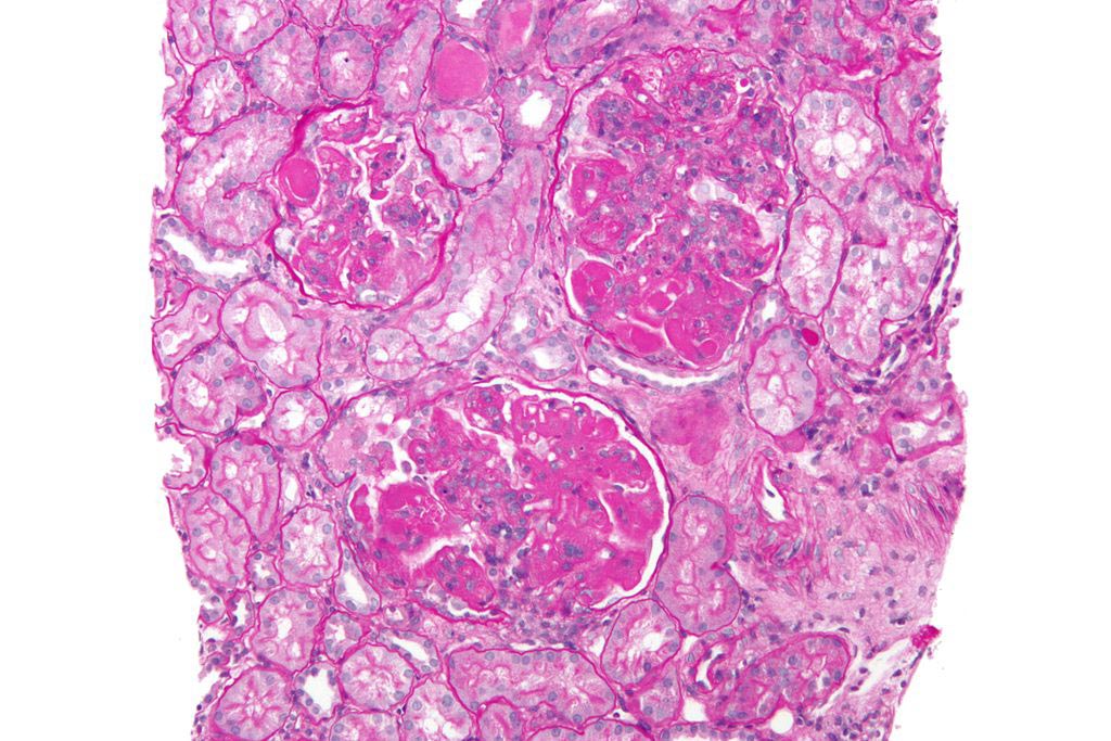Image: A high-magnification micrograph of diffuse proliferative lupus nephritis (Photo courtesy of Wikimedia Commons).