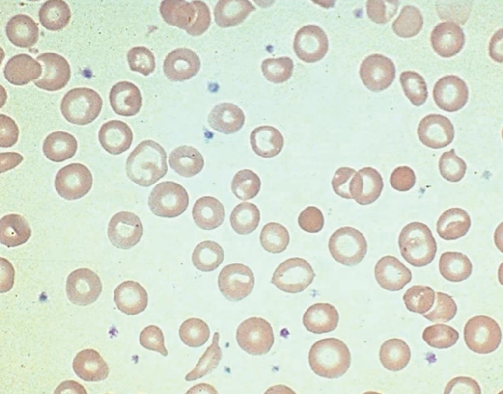 Image: A peripheral blood smear from a patient with iron deficiency anemia: significant hypochromia and microcytosis is seen, as well as moderate variation in size and shape of the red cells (Photo courtesy of American Society of Hematology).