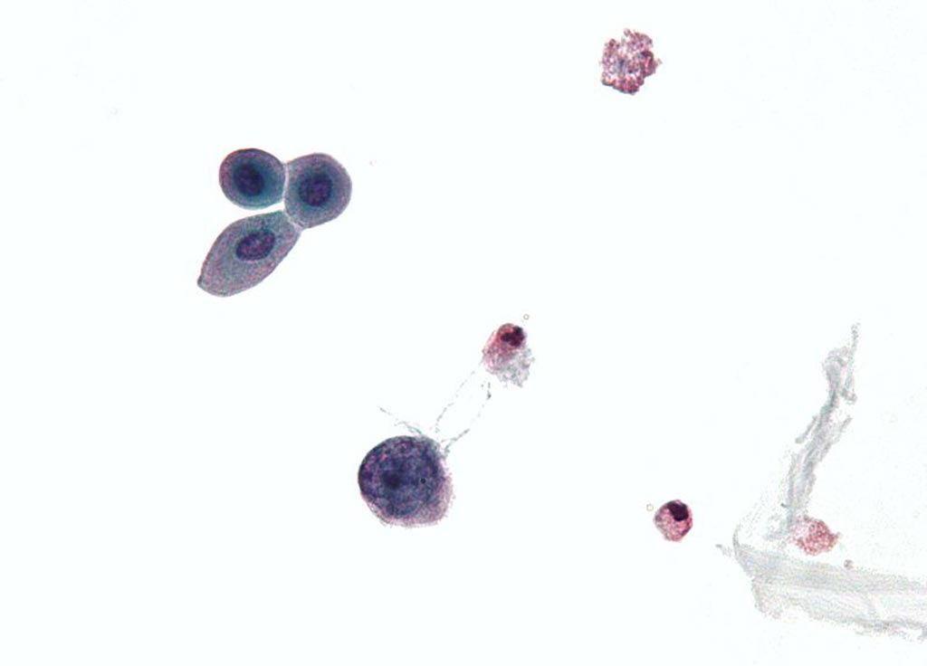 Image: A micrograph of a urine cytology specimen showing a polyomavirus infected cell (Photo courtesy of Wikimedia Commons).