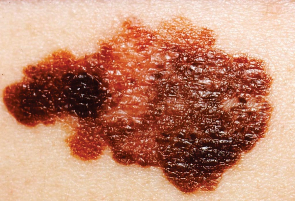 Image: A melanoma on a patient\'s skin. Most melanomas are black or brown, but they may also be skin-colored, pink, red or purple. People with chronic lymphocytic leukemia are at a higher risk for melanomas (Photo courtesy of the National Cancer Institute).