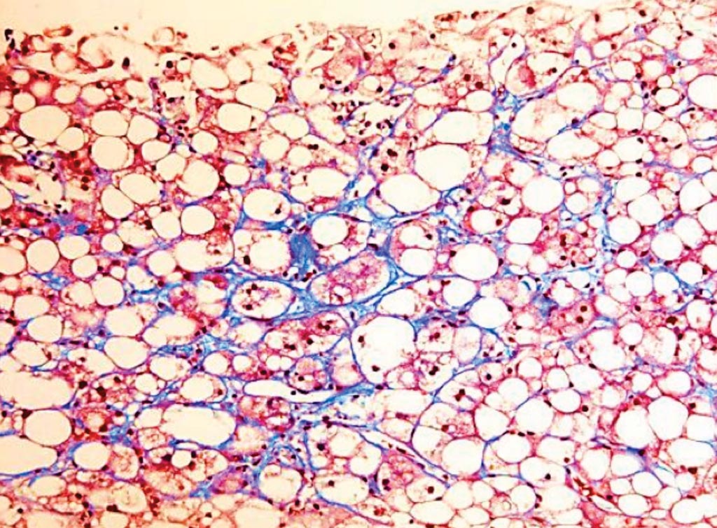 Image: A histopathology of non-alcoholic fatty liver disease showing fibrosis pattern around hepatocytes (Photo courtesy of University Hospital “Marqués de Valdecilla”).