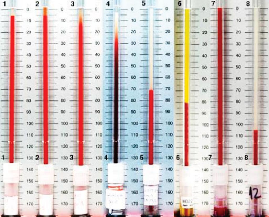 Image: Examples of erythrocyte sedimentation rates (ESR) from normal to pathological conditions. This test indirectly measures the degree of inflammation present in the body (Photo courtesy of The Netherland Association for Hematology).