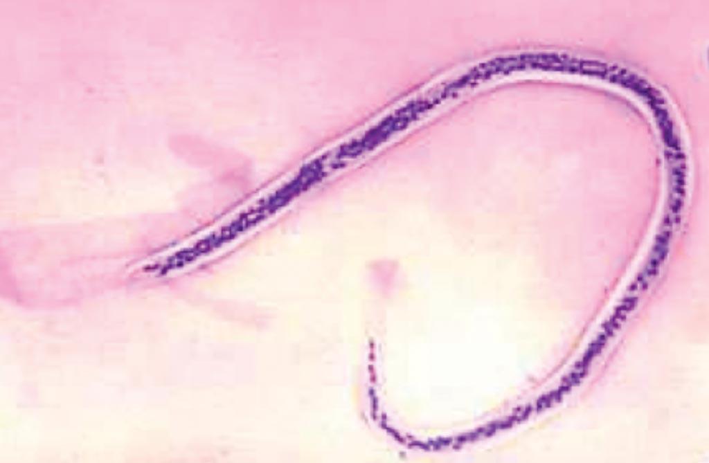 Image: A peripheral blood smear showing Wuchereria bancrofti microfilaria, found in a patient with lymphatic filariasis (Photo courtesy of Medical Chemical Corporation).