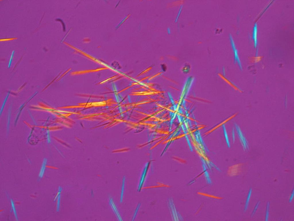 Image: Spiked rods of monosodium urate crystals photographed under polarized light from a synovial fluid sample. Formation of monosodium urate crystals in the joints is associated with gout (Photo courtesy of Wikimedia Commons).