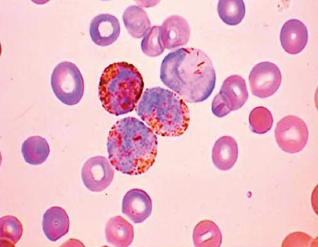 Image: Myeloperoxidase positive staining from a patient with acute myeloid leukemia (Photo courtesy of Monika Nema, MD).