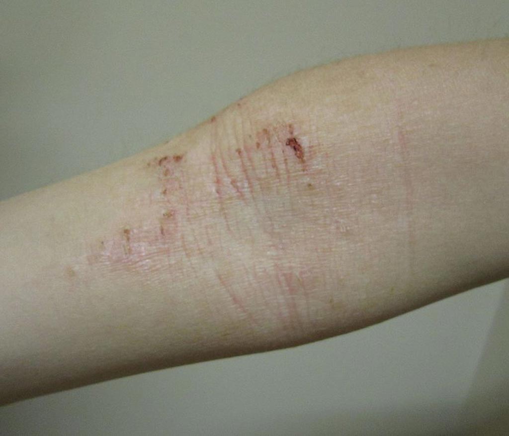 Image: Atopic dermatitis of the inside crease of the elbow (Photo courtesy of Wikimedia Commons).