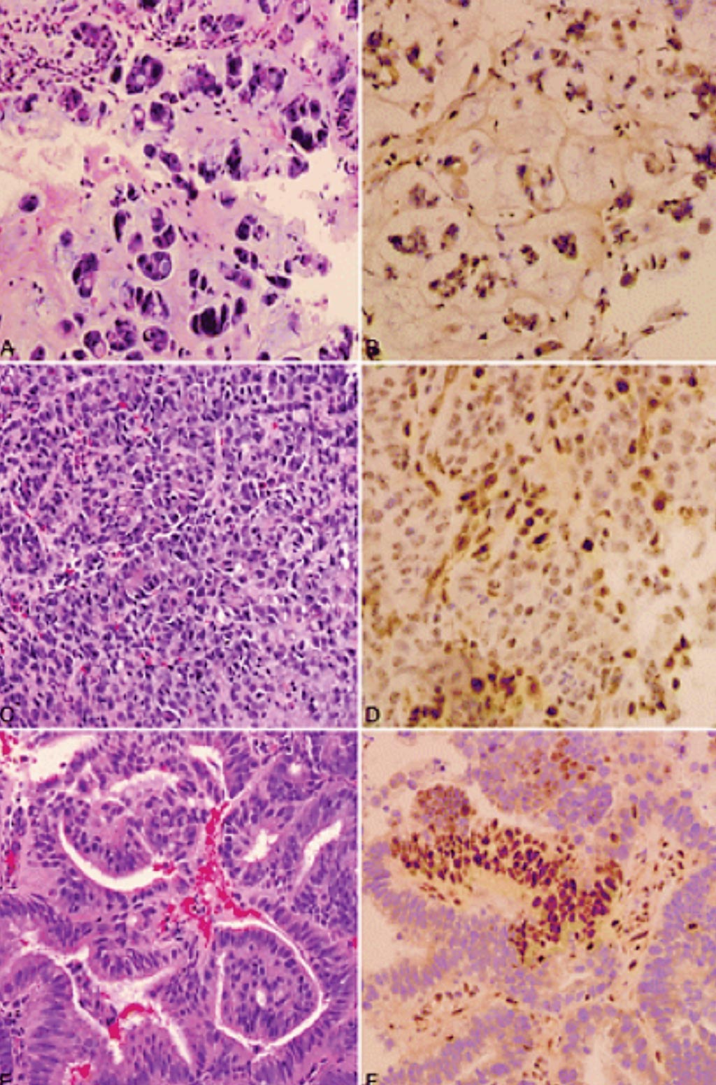 Image: A and B, Mucinous adenocarcinoma of colon and indeterminate PMS2 immunohistochemistry staining. C and D, Poorly differentiated carcinoma of colon and indeterminate MLH1 staining. E and F, Endometrial carcinoma and focal MSH6 staining (Photo courtesy of University of Texas Southwestern Medical Center).