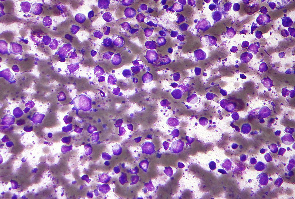 Image: A micrograph of a diffuse large B cell lymphoma (DLBCL) (Photo courtesy of Wikimedia Commons).