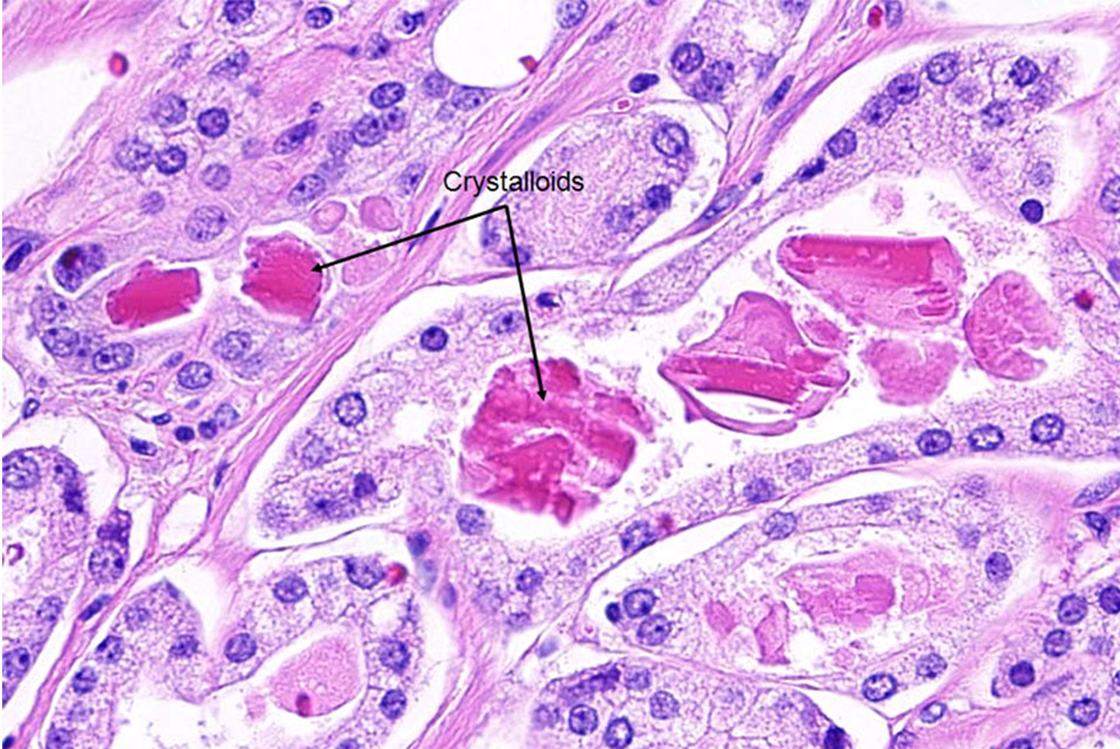 Image: Histopathology of prostate cancer: crystalloids (bright eosinophilic rhomboid to prismatic structures, seen in ~40% cancer) and amorphous eosinophilic secretions (Photo courtesy the American Urological Association).