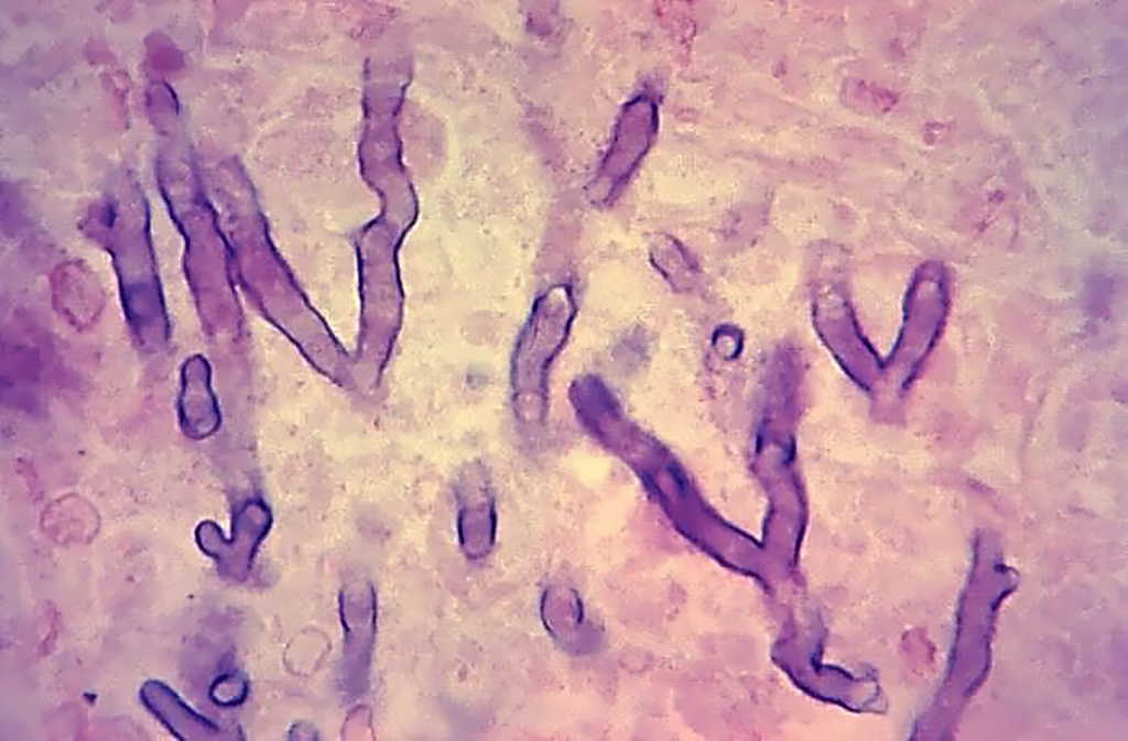 Image: Photomicrograph of a hematoxylin-eosin-stained human lung tissue specimen, harvested from a pulmonary aspergillosis patient. The histopathologic changes indicate the presence of Aspergillus sp. fungal organisms. Note the branching hyphae amongst the lung tissue (Photo courtesy of the Armed Forces Institute of Pathology).