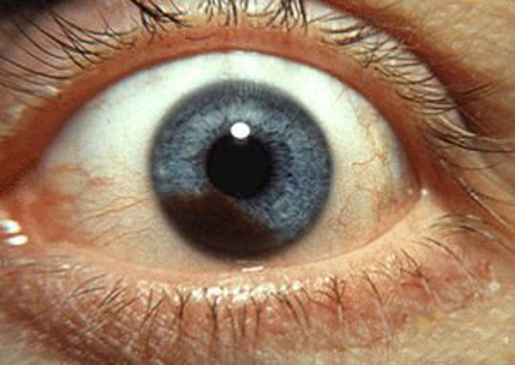 Image: Photograph of an iris melanoma (Photo courtesy of Wikimedia Commons)