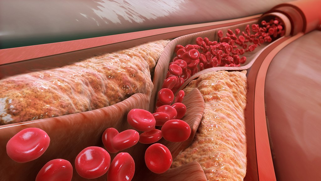Image: Small particle LDL has been associated with the progression of atherosclerosis and blockage the artery lumen, because it can carry cholesterol into smaller vessels. As atheroma enlarges, the arterial wall ruptures and releases blood clots that lead to narrowing of the artery (Photo courtesy of Wikimedia Commons)