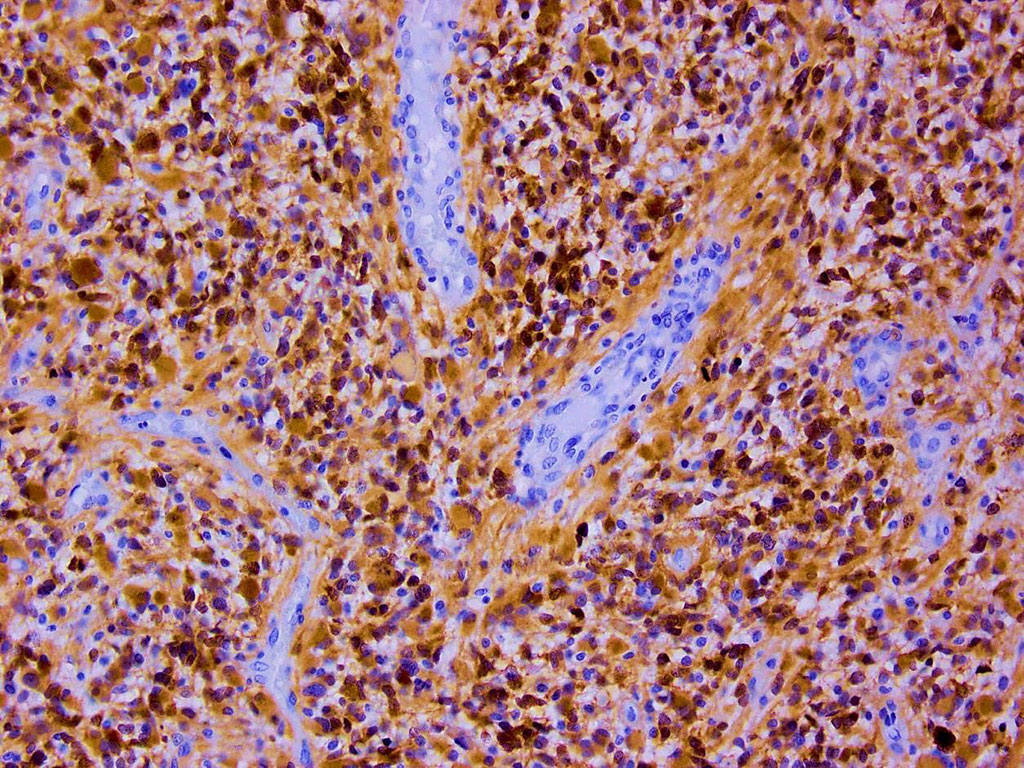 Image: Immunohistochemistry showing expression of mutated IDH1 protein in glioblastoma using a monoclonal antibody targeting the IDH1 R132H mutation (Photo courtesy of Marvin 101)