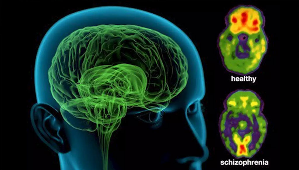 Image: Colored positron emission tomography (PET) scans of axial sections through a healthy brain (upper) and a schizophrenic brain (lower). Genetic architectures of schizophrenia in East Asian and European populations have been compared (Photo courtesy of WebMD)