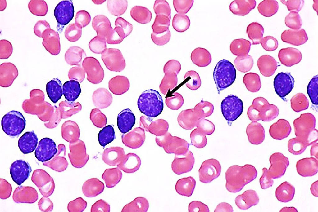 Image: Peripheral blood smear showing chronic lymphocytic leukemia (CLL). A large lymphocyte (arrow) has a notched nucleus and demonstrates the variable appearance of some of the lymphocytes in CLL (Photo courtesy of Peter Maslak)