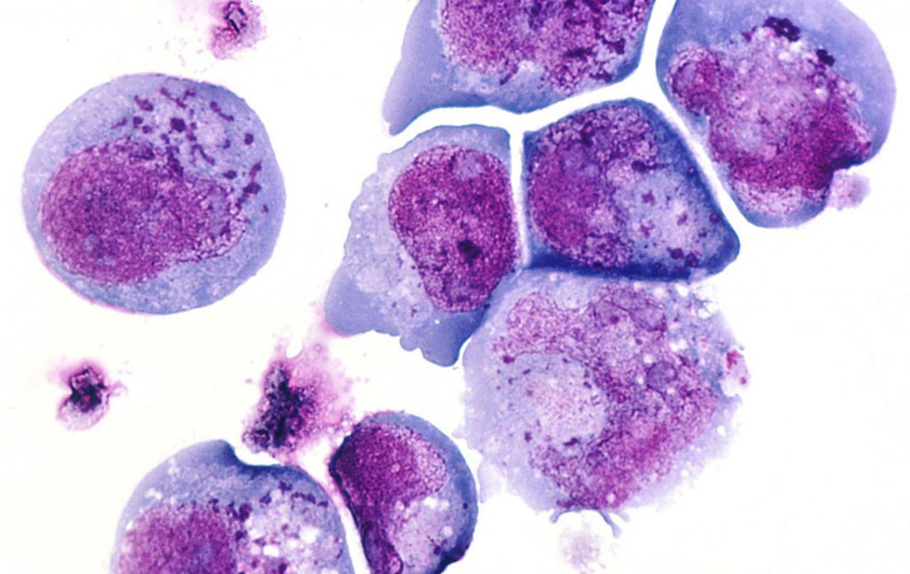 Image: Histological slide of the human herpes virus-6 showing infected cells, with inclusion bodies in both the nucleus and the cytoplasm. A new method has been developed to separate between two different types of a common herpes virus, and HHV-6 has been linked to multiple sclerosis (Photo courtesy of National Cancer Institute)