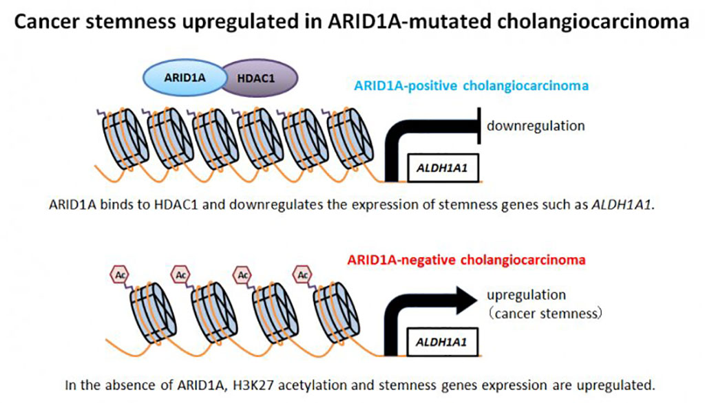 Image: Loss of the ARID1A tumor suppressor gene increases the aggressiveness of intrahepatic cholangiocarcinoma (Photo courtesy of Tokyo Medical and Dental University)