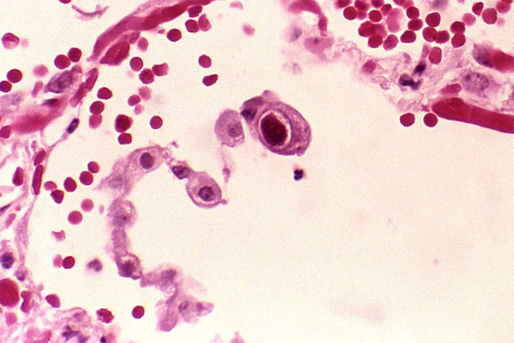 Image: Photomicrograph of a lung tissue specimen from a patient with an active cytomegalovirus infection. Histopathology revealed the presence of a cytomegalic pneumocyte, which contained the characteristic intranuclear, owl eye inclusion (Photo courtesy of [U.S.] Centers for Disease Control and Prevention)