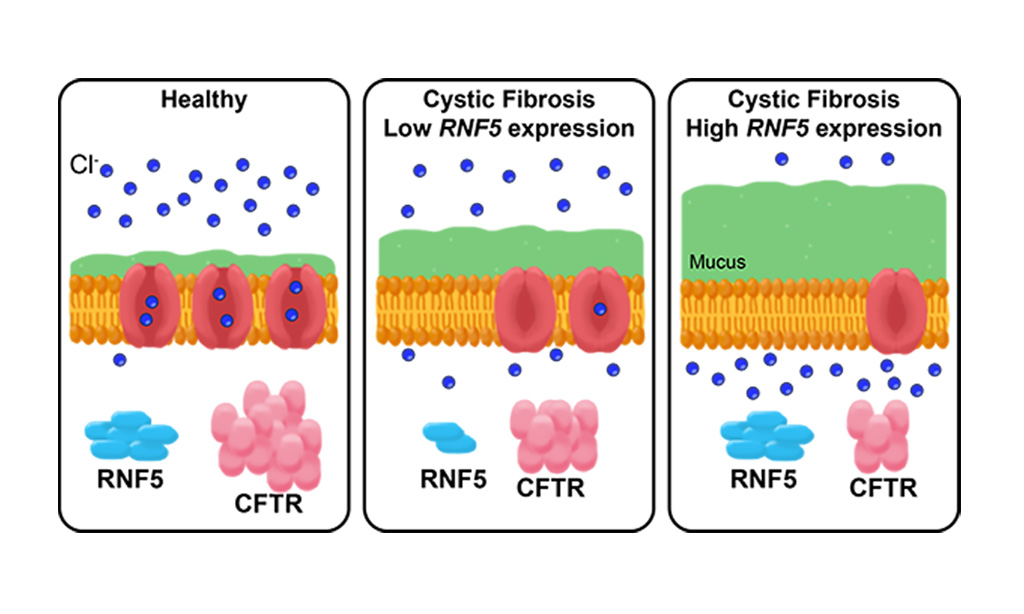 Image: In healthy people, the CFTR protein is embedded in the membrane of most cells, where it forms a channel for chlorine ions. In people with cystic fibrosis, an inherited mutation in the CFTR gene means their channels do not work as well and cells produce more mucus. The RNF5 protein inhibits CFTR, so people with cystic fibrosis who have genetic variations that decrease RNF5 expression have CFTR channels that function a little better, and thus are not as prone to infections as people with high RNF5 expression (Photo courtesy of University of California, San Diego)
