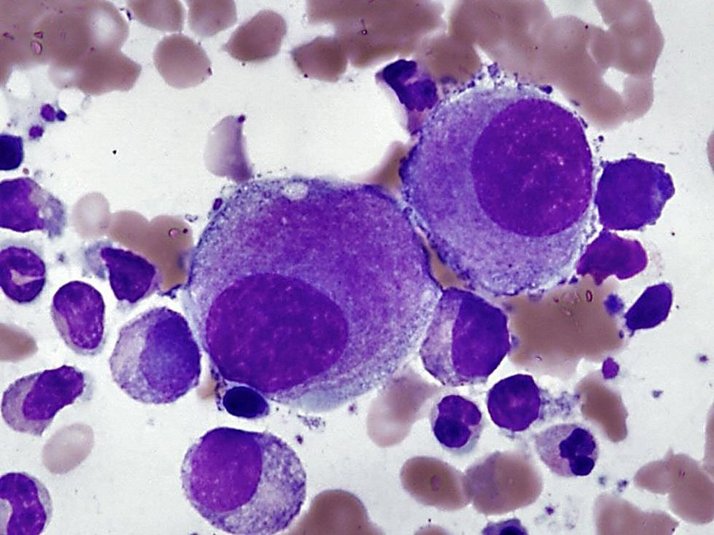 Image: Bone marrow film from a patient with myelodysplastic syndrome demonstrates small hypolobated megakaryocytes that are typical of the syndrome with isolated del(5q) (Photo courtesy of John P. Hunt, MD)