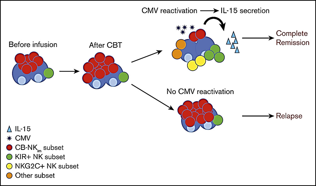 Image: Schematic diagram of how novel immature natural killer cell subpopulation predicts relapse after cord blood transplantation (CBT) (Photo courtesy of MD Anderson Cancer Center).